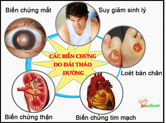 hỗ trợ bệnh tiểu đường bằng nụ vối hiệu quả tại nhà